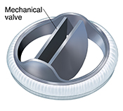 Mechanical heart valve.