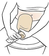 Person sitting on toilet cleaning ostomy pouch.