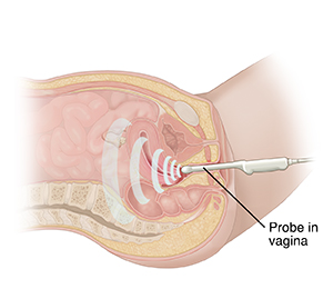 Cross section of female pelvis viewed from side. Ultrasound transducer placed in vagina.