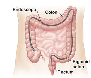 Endoscope with light inserted through rectum, past sigmoid colon, and through entire colon.