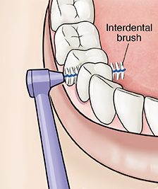 Closeup of interdental brush cleaning between teeth.