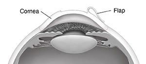 Cross section of eye showing flap in cornea.