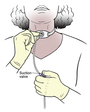 Woman inserting suction catheter into tracheostomy tube in neck, showing suction valve in one hand..