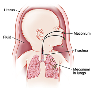 Baby in uterus showing trachea and lungs, with meconium in amniotic fluid and going in nose and mouth into lungs.