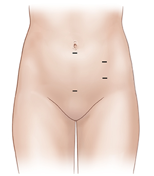 Front view of female abdomen showing possible laparoscopic incision sites in pelvic area.