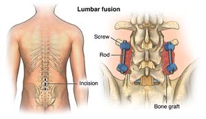  Back view of a male figure with an incision and closeup of hardware for a lumbar fusion.