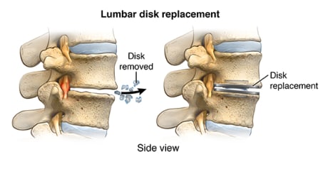 Side view of lumbar disk showing where disk was removed and showing where new artificial disk was placed.