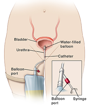 Person's bladder with catheter and urine bag on leg, with detail of draining balloon with syringe at port.