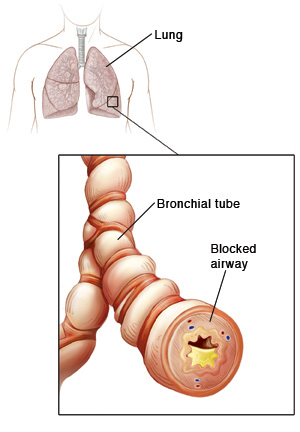 Outline of human chest showing trachea and lungs. Closeup of bronchial tube showing inflammation and mucus buildup.