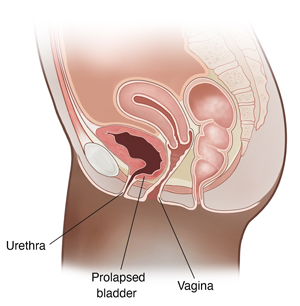 Side view cross section of female pelvis showing prolapsed bladder (cystocele).