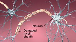 Closeup of neuron showing myelin sheath damage.