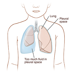 Front view of child showing healthy left lung and fluid trapped between compressed right lung and body wall.