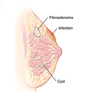 Cross-section side view of breast showing breast problems of cyst, infection, and fibroadenoma..