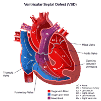 Anatomy of a heart with ventricular septal defect