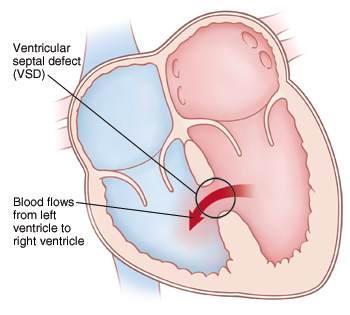 Front view cross section of heart showing ventricular septal defect (VSD) allowing blood to flow from left ventricle to right ventricle.
