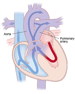 Four-chamber view of heart showing truncus arteriosus. Arrows indicate blood flowing from both ventricles to pulmonary artery and aorta.