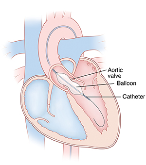 Front view cross section of heart showing balloon valvuloplasty for aortic stenosis.