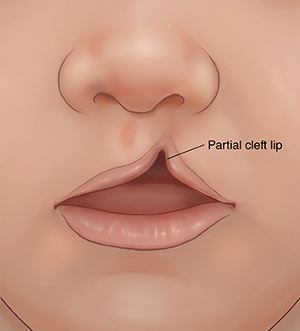 Front view of child's nose and mouth showing partial cleft lip. 