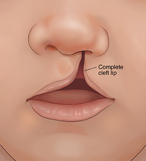 Front view of child's nose and mouth showing complete cleft lip.