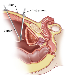 Side view of cross section of child's pelvis showing bladder and urethra. Tools are inserted in pelvis through skin. One tool is shining light where another tool is grasping part of urinary tract.