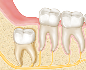 Teeth in cross section of jawbone. Wisdom tooth is in bone under gum, pointing straight upward.