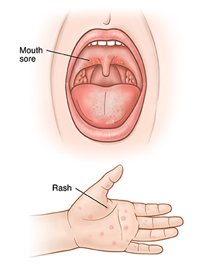 Open mouth showing sores on back of roof of mouth. Closeup of palm of hand showing red rash.