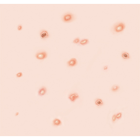 Closeup of skin with chickenpox rash.