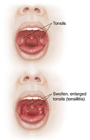 Front view of face with open mouth comparing oral cavity and tonsils with inflamed throat and enlarged tonsils.