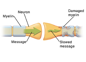 Closeup of synapse where two neurons meet. Arrows show message moving through healthy neuron and being disrupted in damaged neuron.