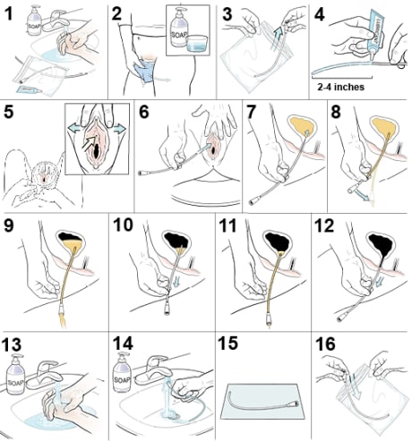 16 steps showing how to insert a female urinary catheter.