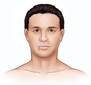 Front view of adult's face showing impetigo around nose and mouth.