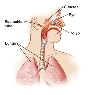 Outline of head and chest with head turned to side showing swollen sinuses, nasal polyps, postnasal drip, and red eye.