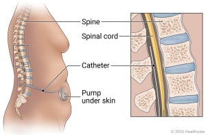 Sideview of the torso with catheter inserted into the spine near the spinal cord. A pump is also under the skin near the belly button, connected to the catheter.