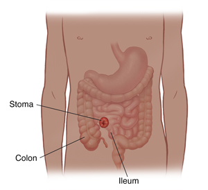 Front view of child's body showing digestive tract and stoma.