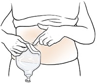 Closeup of abdomen showing hands removing urostomy pouch.