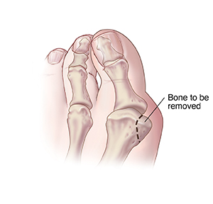 Top view of big toe with dotted line showing bone to be removed for bunion chevron head osteotomy.