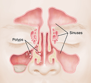 Front view of face showing sinuses with polyps in sinuses.