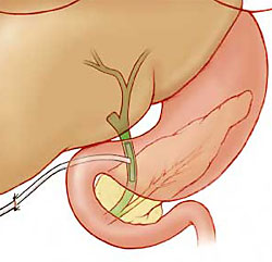 Close up of the T-tube connected to the bile duct.
