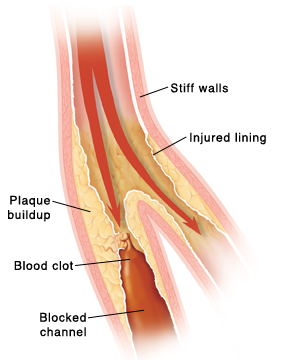 Cross section of artery showing blood flow blocked by plaque and clot.