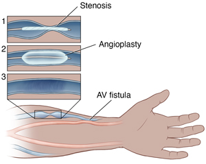 Forearm with narrowed vein connected to artery used for dialysis, with detail showing steps of angioplasty to fix vein.