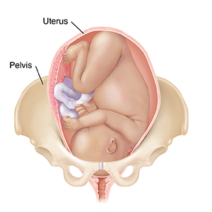 Front view of full-term fetus in uterus between pelvic bones with head down.