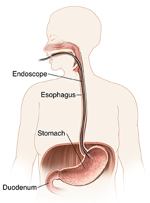 Outline of woman showing mouth, esophagus, and stomach with endoscope inserted through mouth into stomach.