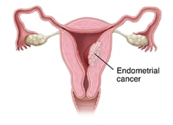 Front view cross section of female reproductive organs showing cancer in uterus.