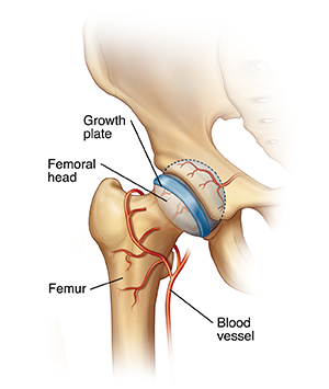 Front view of hip joint showing femur and femoral head fitting into socket in pelvis. Blood vessels wrap around femur and go to femoral head. Growth plate is across femoral head.