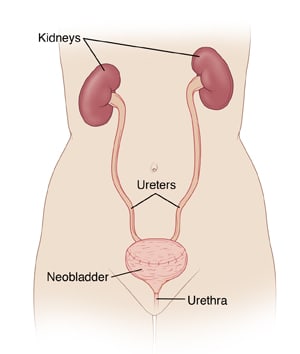 Front view of female torso, showing kidneys connected by ureters to neobladder.