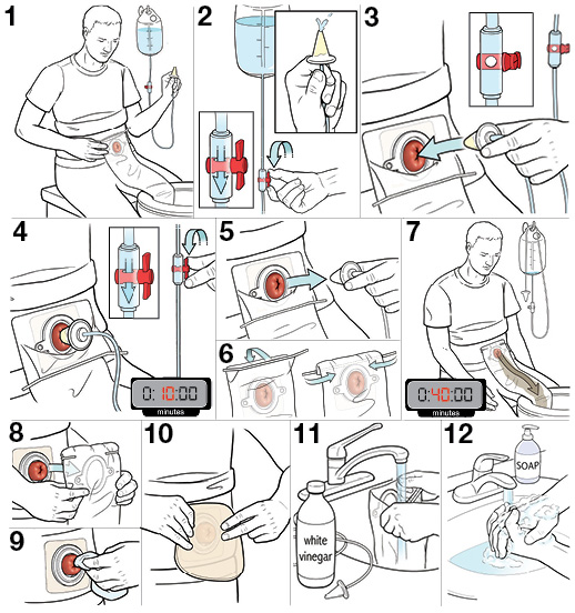 12 steps for irrigating your stoma