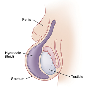 Closeup of penis and scrotum showing testicle inside surrounded by large sac of fluid (hydrocele).