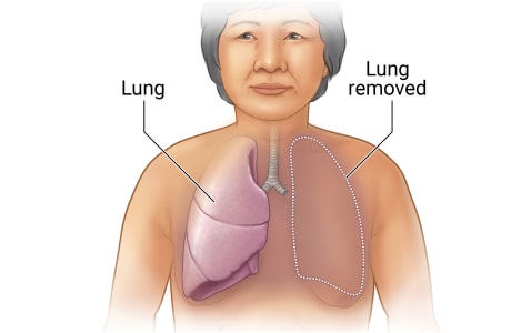 Person with right lung intact and left lung removed.