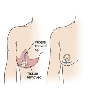 Breast tissue removed in breast reduction surgery, higher nipple location, and closed incision.