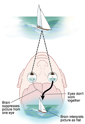 View of eyes and brain from top of head showing blurry vision in one eye because of amblyopia. Image from blurry eye not processed in brain.